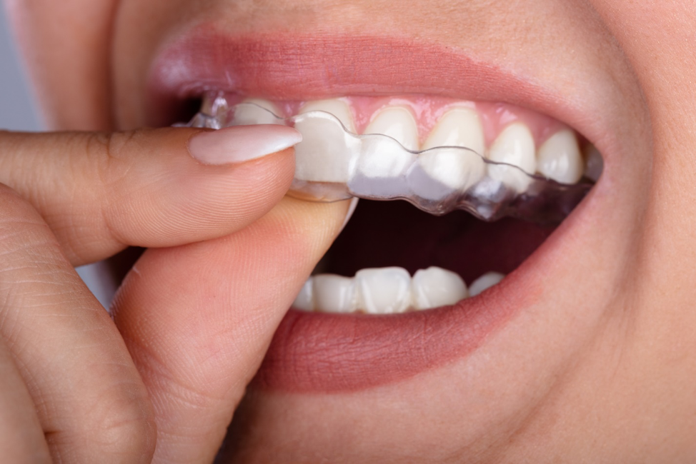 What Happens If You Lose Your Invisalign® Trays?: Dental Art of